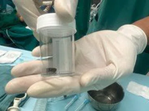 Lấy cuống xoài trong đường thở của bé 8 tháng tuổi