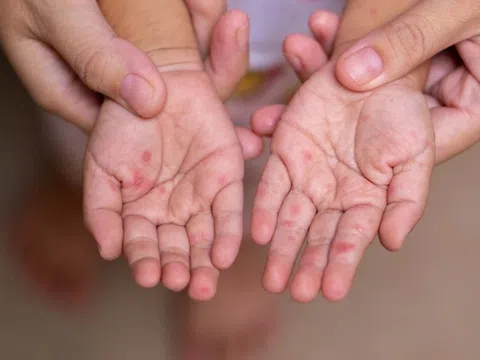 Cách chăm sóc trẻ nhỏ bị mắc sởi