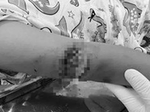 Sang nhà hàng xóm chơi, bé gái bị chó cắn thấu xương cánh tay