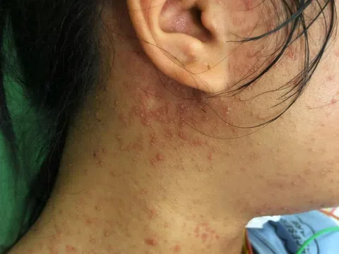 Cô gái suýt mất mạng vì căn bệnh quen thuộc