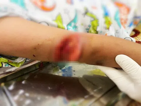 Bé gái bị chó nhà hàng xóm cắn rách cánh tay