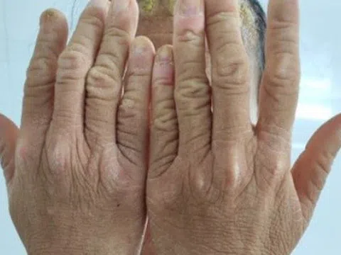 Căn bệnh khiến cô gái sinh ra với lớp vảy sừng toàn thân