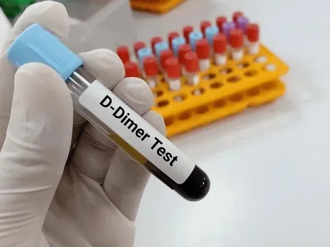 Hai tình huống nếu có cục máu đông sau tiêm vaccine Covid-19
