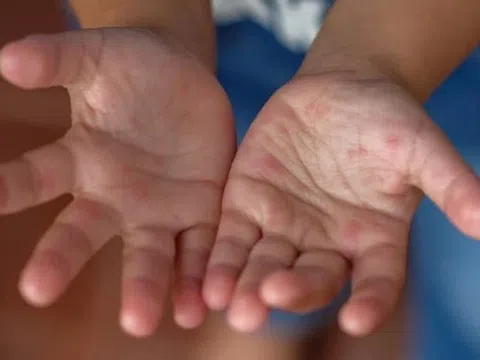 Bệnh tay chân miệng tăng mạnh ở Đồng Nai