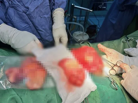 Người đàn ông mang khối u tinh hoàn nặng gần 1 kg