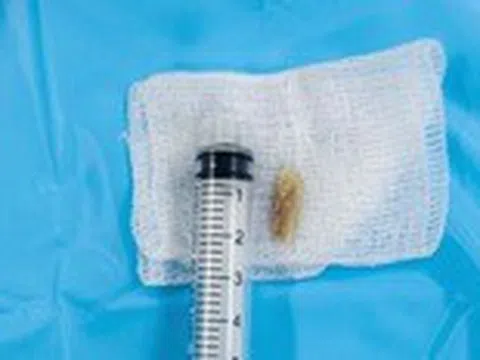 Mắc xương vịt 2cm ở thực quản và thanh quản, người phụ nữ không ăn không nói được