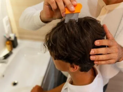 Bé trai bị lây bệnh nấm tổ ong da đầu