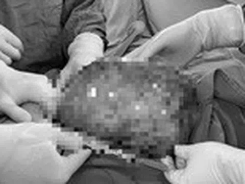 Nguy kịch vì ‘nuôi’ khối u trong bụng suốt hơn một năm