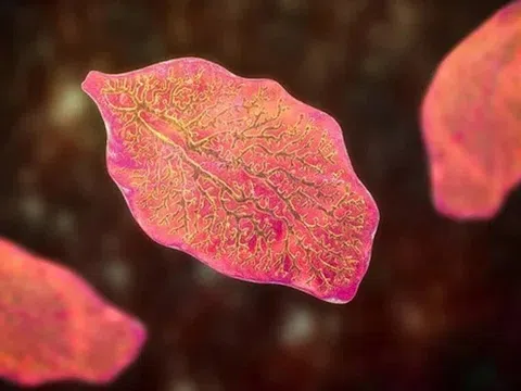 Dấu hiệu khi nhiễm sán lá gan