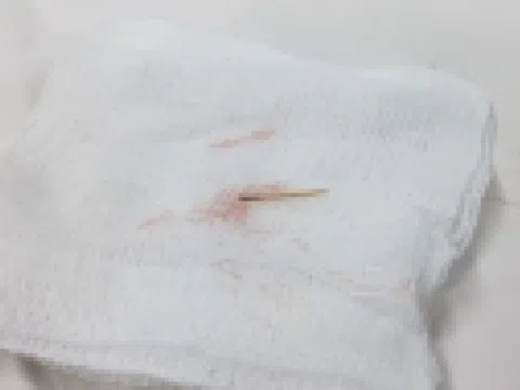 'Thủ phạm' không ngờ khiến người phụ nữ đau bụng liên tục