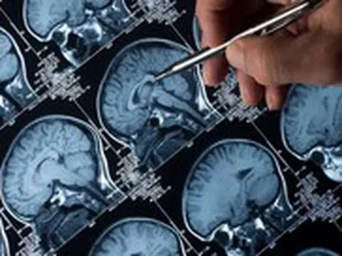 AI giúp phân loại khối u não chỉ trong vài giờ