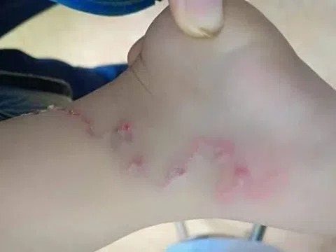 Nhiễm bệnh từ thú cưng