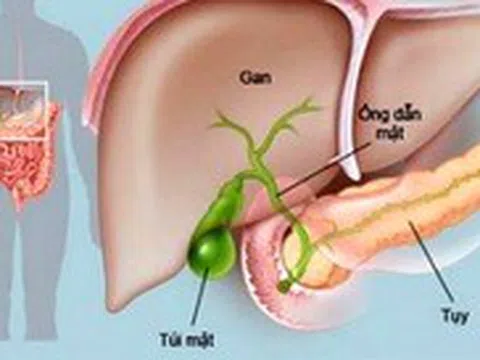 Viêm tụy cấp: Máu đục như sữa