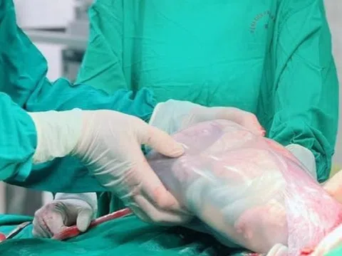 Em bé chào đời trong bọc điều hiếm gặp