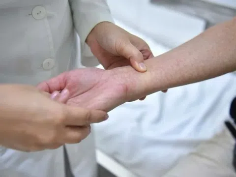 Hết sốt chưa chắc đã khỏi sốt xuất huyết