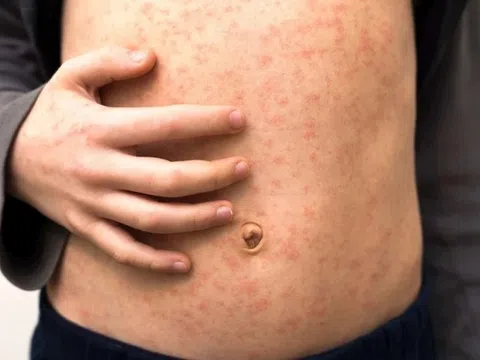 TP.HCM ghi nhận 2 ca bệnh sởi đầu tiên trong năm