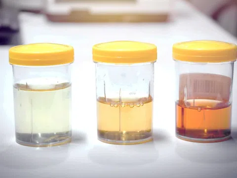 Màu nước tiểu nói lên điều gì về sức khỏe