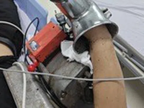 Vào viện với cánh tay lủng lẳng máy xay thịt