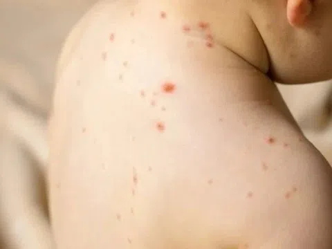 TP.HCM ghi nhận thêm 2 ca bệnh sởi