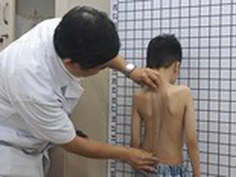 Cong vẹo cột sống, không chỉ ảnh hưởng đến thẩm mỹ