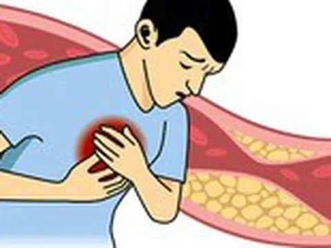 Dùng thuốc trị mỡ máu sai nguy hại hơn cả không dùng thuốc