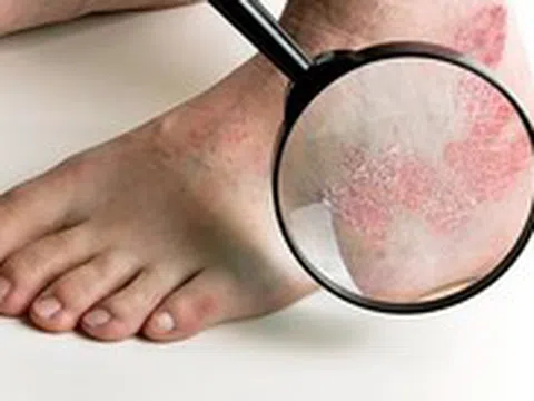 4 bệnh nấm da phải cẩn thận mùa mưa: Bác sĩ chỉ cách chăm sóc đúng
