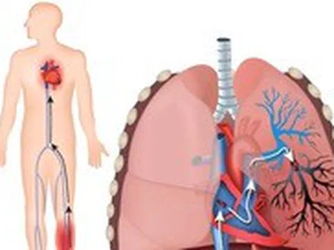 Cứu sống thai phụ ngừng tim do thuyên tắc phổi cấp, cận 'cửa tử'