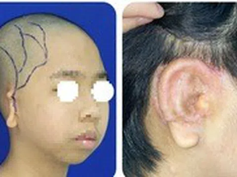 Bé trai lép nửa mặt, dị tật tai nhỏ được phẫu thuật thành công