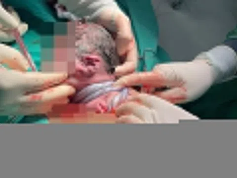 Em bé chào đời với dây rốn quấn 3 vòng cổ