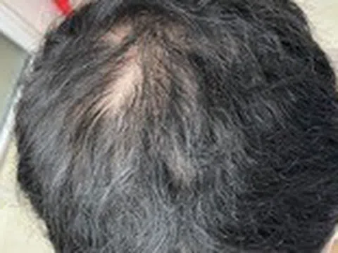 Đi khám vì rụng tóc, chàng trai bất ngờ khi bác sĩ thông báo nguyên nhân