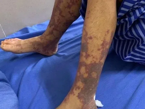 Cơ thể thâm tím gây ám ảnh của người nhiễm liên cầu lợn