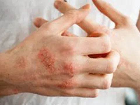 Nổi mụn nước, ngứa dữ dội về đêm… khả năng do ghẻ cái