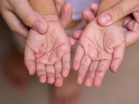 Cần làm gì khi trẻ bị tay chân miệng?