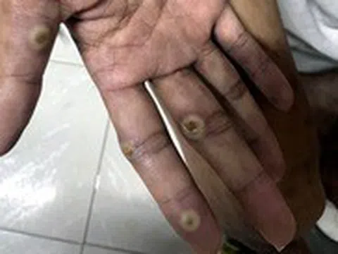 Chàng trai 28 tuổi ở Đồng Nai dương tính với bệnh đậu mùa khỉ