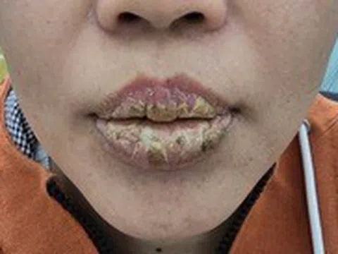 Tưởng xăm môi để có ‘làn môi căng mọng’ ai ngờ môi sưng, đóng mài dày