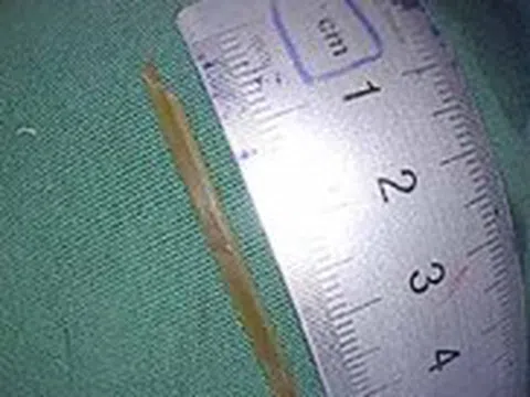 Ăn lẩu bị nhánh sả dài 3,5cm... cắm sâu thành dạ dày