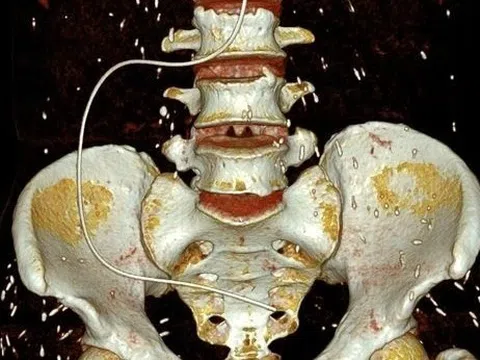 Hình ảnh sán ký sinh khắp cơ thể người phụ nữ