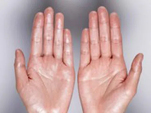 Cứ lo âu, căng thẳng là mồ hôi tay chảy thành giọt, vì sao?