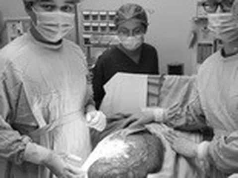 Nam thanh niên 23 tuổi tưởng 'phát tướng' béo bụng, ngờ đâu ‘ôm’ khối u 8kg