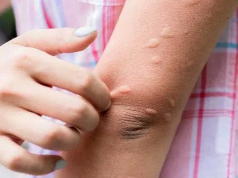 Cảnh giác với bệnh viêm não Nhật Bản với trẻ em trong mùa hè