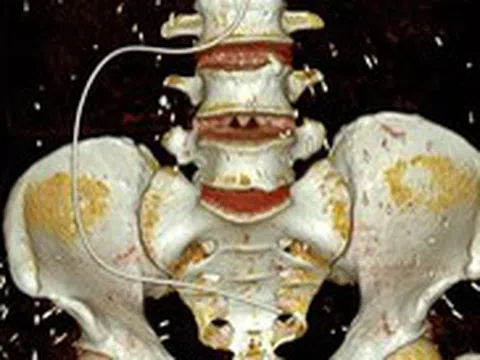 Chụp CT, tá hỏa phát hiện sán rải rác khắp cơ thể người bệnh