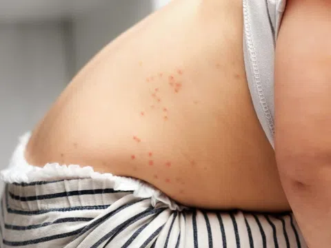 Thời điểm nên tiêm vaccine sởi cho trẻ
