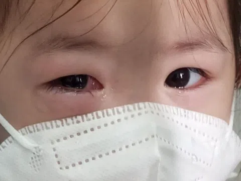 Làm gì khi bị đau mắt đỏ?