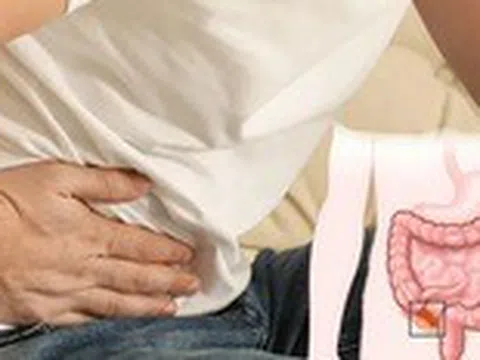 Đau bụng bất thường, cẩn trọng viêm ruột thừa cấp