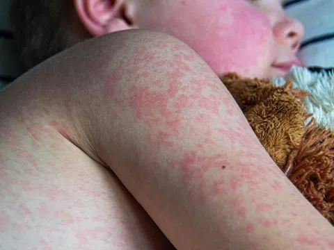 6 cách điều trị phát ban do nhiệt