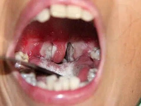 Chăm sóc trẻ bị bệnh bạch hầu