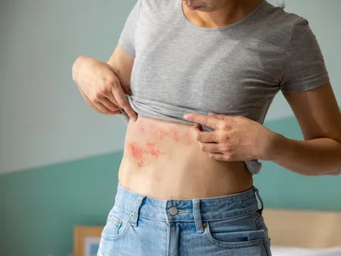 Nguyên nhân, triệu chứng và phòng ngừa thủy đậu