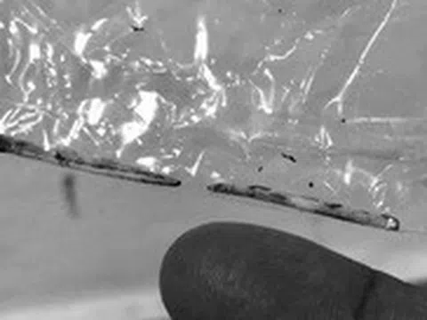 Bất ngờ đoạn xương cá dài 4cm mắc trong gan nam thanh niên