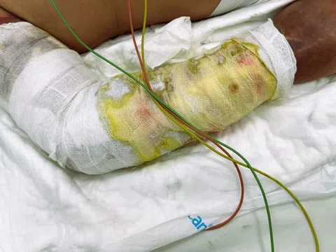 Người đàn ông nhiễm vi khuẩn 'ăn thịt người'