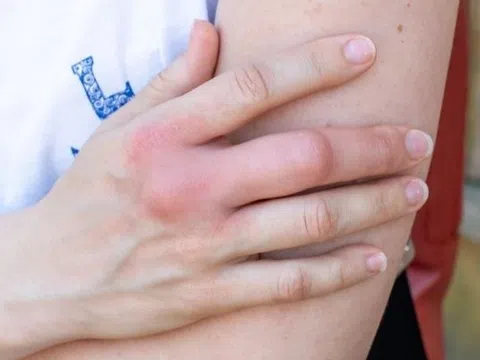 Một dấu hiệu cảnh báo bệnh thận không nên bỏ qua